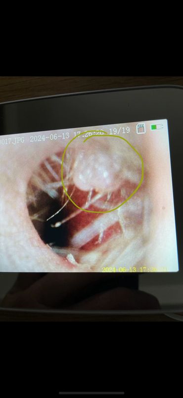 Small growth on lateral ear canal.