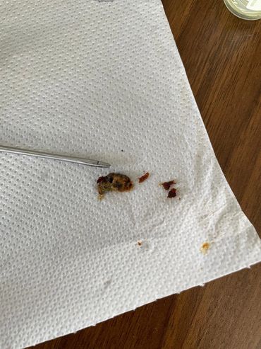 Plug of wax removed using a combination of Microsuction and warm water irrigation. What a relief!