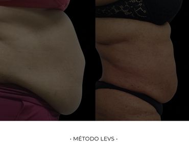 Emagrecimento com redução de gordura visceral comprovada