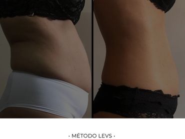 Paciente com redução significativa de gordura e manutenção de músculos