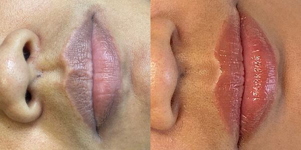 Before and after of client who has had a lip neutralization treatment.