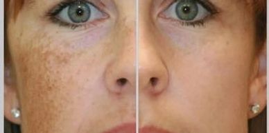Skin tag removal, skin imperfection removal services