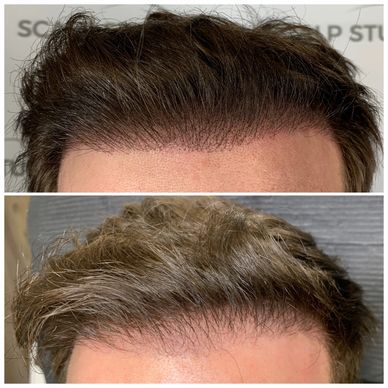 mans hairline that has been tattooed to give a fuller appearance.