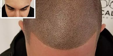 scalp micropigmentation. man with receding hairline