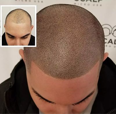 scalp tattooing for a balding male