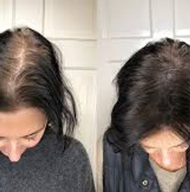 woman's hairline that has been treated with smp.