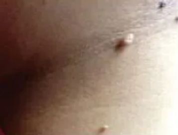 Skin tag removal