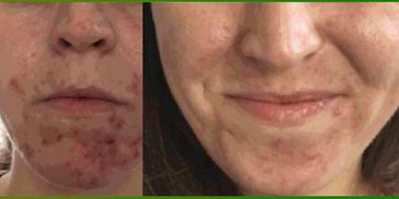 Herbal Power Peel Before and after acne treatment with chemical free deep sea algae peel.