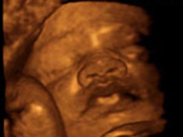 3-D ULTRASOUND