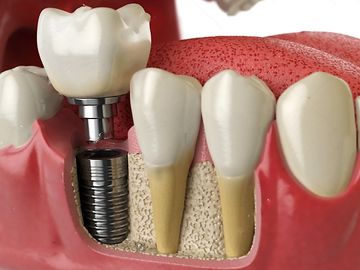Implantes Dentales.