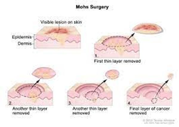 Mohs Surgery Diagram - Skin Cancer Surgery