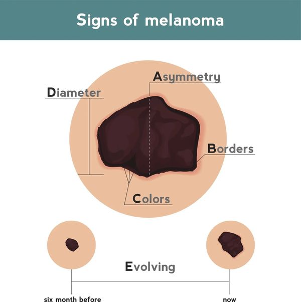 signs of Melanoma drawing
