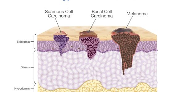 skin cancer on skin lesions diagram