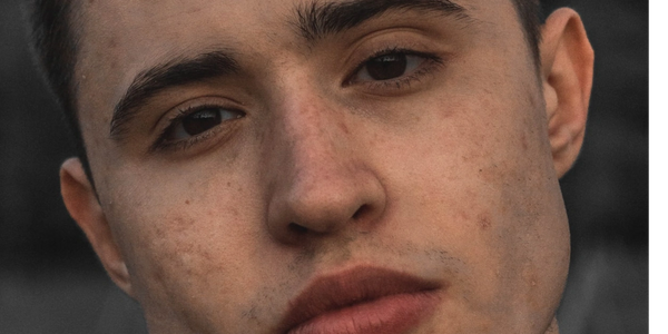 young man with acne