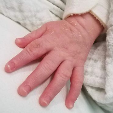 The characteristic bullet-shaped fingers of MSS