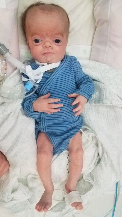 A newborn boy with MSS wears a blue striped outfit. He has a tracheostomy and ventilator.