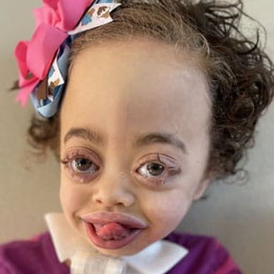 A girl with MSS smiles at the camera with large, beautiful eyes. She has brown curly hair.