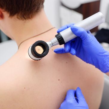 Doctor examining skin on a person's back with a dermatoscope.