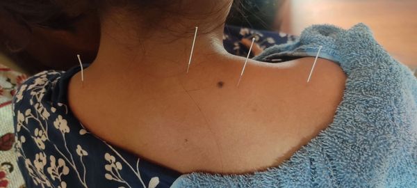 Dry needling for upper trapezius muscle