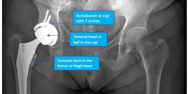 X-ray showing a hip replacement with labeled parts.