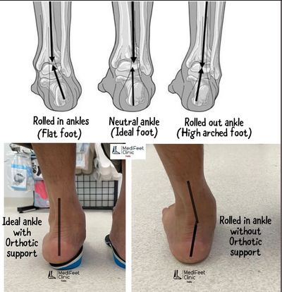 Orthotics to support your feet and putting your feet in its ideal neutral position