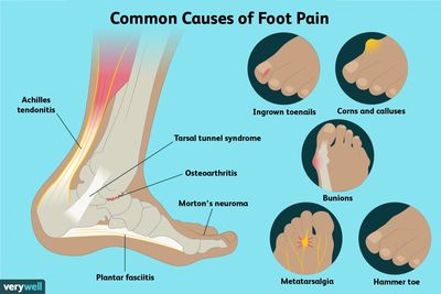 Common foot conditions including plantar fasciitis, heel and arch pain, bunions and hammer toes.