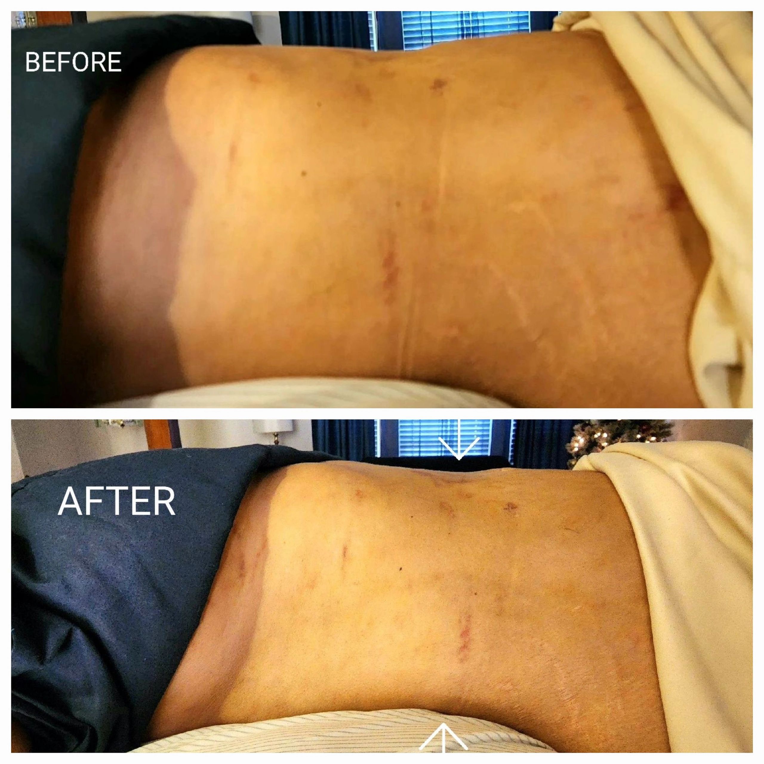 the swelling in stomach before and after lymphatic drainage massage