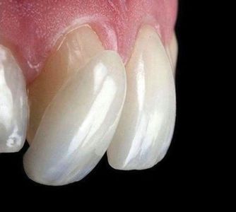 Image of Porcelain cosmetic veneer improves the size shape and color