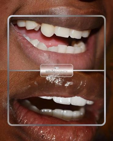 E.max veneers correcting discoloured teeth and Gaps closure, before and after, Dr. Habib Zarifeh Bei