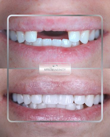 Dental implant smile makeover, before and after, Dr. Habib Zarifeh Smile Infinity Beirut