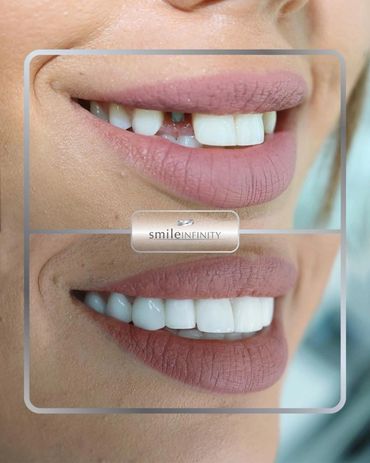 Dental implant closing a missing front tooth gap, before and after, Dr. Habib Zarifeh Beirut Lebanon