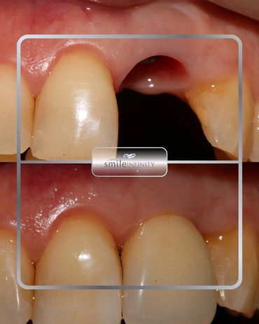 Single dental implant replacing a missing upper tooth, before and after, Smile Infinity Beirut