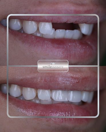 One Day Implant full-smile restoration of broken teeth, before and after, Beirut Lebanon