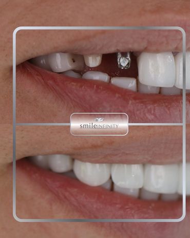Front tooth replaced with a dental implant, before and after, Smile Infinity Beirut