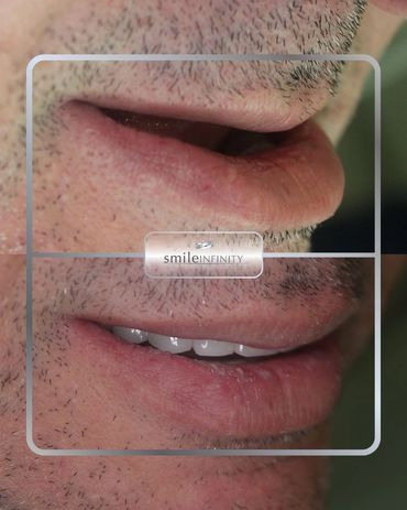 All-on-4 dental implants full-arch smile, before and after, Dr. Habib Zarifeh Beirut Lebanon
