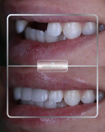 Front tooth replaced with a dental implant, before and after, Smile Infinity Beirut