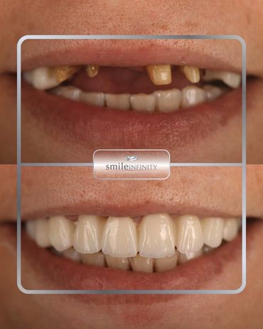 Worn and broken teeth restored with dental implants and crowns, before and after, Beirut