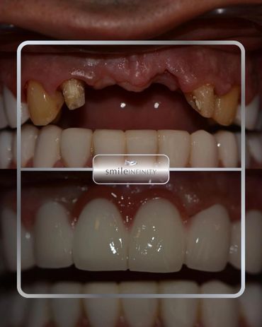 Implant crown replacing a missing upper front tooth, before and after, Smile Infinity Beirut