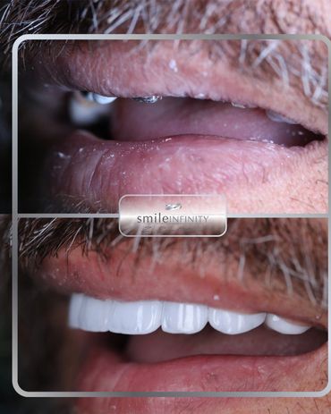 Full-arch fixed implant bridge replacing missing teeth, before and after, Beirut Lebanon