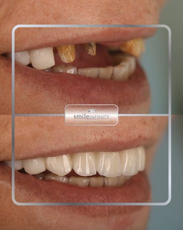 One Day Implant full-smile restoration of broken teeth, before and after, Beirut Lebanon