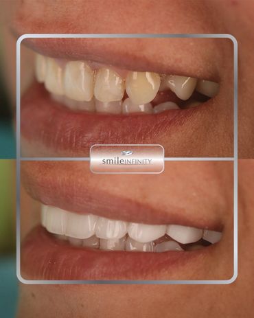 Porcelain veneers side-profile result on worn teeth, before and after, Smile Infinity Beirut
