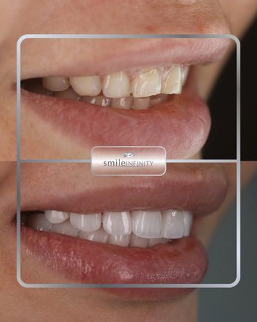 Emax porcelain veneers brightening stained teeth, before and after, Dr. Habib Zarifeh Beirut Lebanon