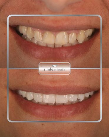 E.max porcelain veneers full smile makeover, before and after, Smile Infinity Beirut