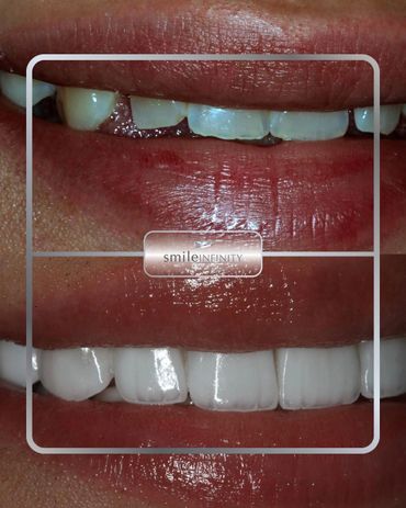 E.max porcelain veneers brightening stained teeth, before and after, Dr. Habib Zarifeh Beirut Lebano