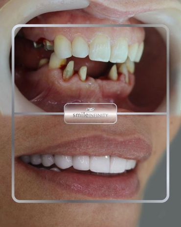 Broken upper front teeth rebuilt with dental implants, before and after, Smile Infinity Beirut