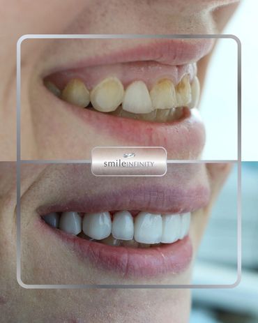 Hollywood Smile veneers with lip aesthetics, before and after, Smile Infinity Beirut