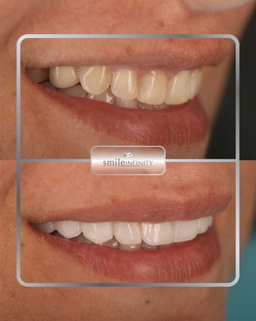 ZEvolution no-prep veneers brightening a natural smile, before and after, Smile Infinity Beirut
