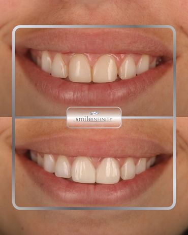 ZEvolution no-prep veneers smile transformation, before and after, Smile Infinity Beirut Lebanon