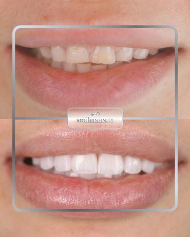 ZEvolution no-prep veneers restoring worn and uneven teeth, before and after, Dr. Habib Zarifeh Beir