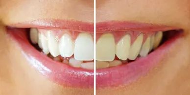 Professional strength whitening for $149 - save an average of $200 in the Chesterfield area